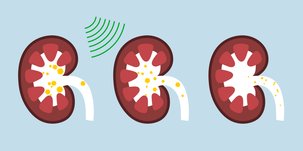 Stoßwellen-Lithotrypsie