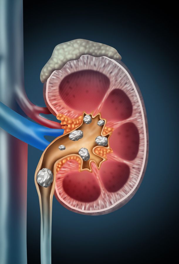 Nierensteine in Niere